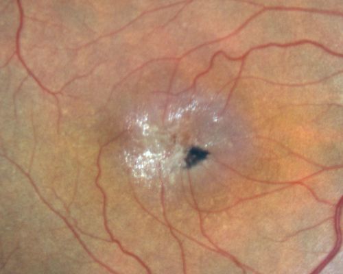 Juxtafoveal Telangiectasis - After Hemorrhage Absorbed Right Eye with Avastin Injections
73-year-old woman has juxtafoveal retinal telangiectasis in both eyes.  The right eye has stage 5 disease.  Her last Avastin treatment in the right eye was in 6 months ago.  The right eye has been the worst of her two eyes for years.

VISUAL ACUITY: Vision OD is 20/200, OS is 20/50.  

