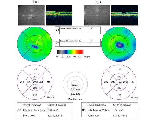 Juxtafoveal Telangiectasis - After Hemorrhage Absorbed Right Eye with Avastin Injections
73-year-old woman has juxtafoveal retinal telangiectasis in both eyes.  The right eye has stage 5 disease.  Her last Avastin treatment in the right eye was in 6 months ago.  The right eye has been the worst of her two eyes for years.

VISUAL ACUITY: Vision OD is 20/200, OS is 20/50.  


