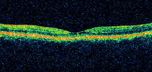 Juxtafoveal Telangiectasis - After Hemorrhage Absorbed Right Eye with Avastin Injections
73-year-old woman has juxtafoveal retinal telangiectasis in both eyes.  The right eye has stage 5 disease.  Her last Avastin treatment in the right eye was in 6 months ago.  The right eye has been the worst of her two eyes for years.

VISUAL ACUITY: Vision OD is 20/200, OS is 20/50.  

