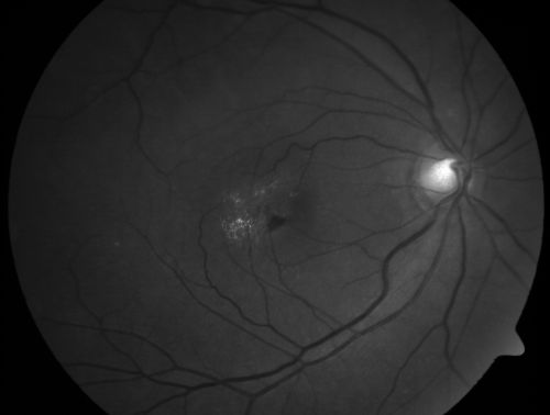 Juxtafoveal Telangiectasis - After Hemorrhage Absorbed Right Eye with Avastin Injections
73-year-old woman has juxtafoveal retinal telangiectasis in both eyes.  The right eye has stage 5 disease.  Her last Avastin treatment in the right eye was in 6 months ago.  The right eye has been the worst of her two eyes for years.

VISUAL ACUITY: Vision OD is 20/200, OS is 20/50.  

