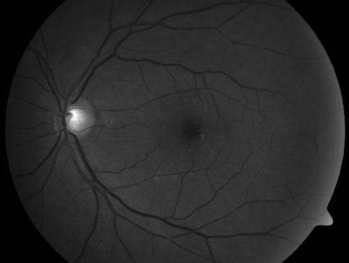 Juxtafoveal Telangiectasis - After Hemorrhage Absorbed Right Eye with Avastin Injections
73-year-old woman has juxtafoveal retinal telangiectasis in both eyes.  The right eye has stage 5 disease.  Her last Avastin treatment in the right eye was in 6 months ago.  The right eye has been the worst of her two eyes for years.

VISUAL ACUITY: Vision OD is 20/200, OS is 20/50.  

