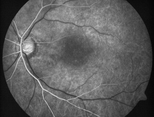 Juxtafoveal Telangiectasis - After Hemorrhage Absorbed Right Eye with Avastin Injections
73-year-old woman has juxtafoveal retinal telangiectasis in both eyes.  The right eye has stage 5 disease.  Her last Avastin treatment in the right eye was in 6 months ago.  The right eye has been the worst of her two eyes for years.

VISUAL ACUITY: Vision OD is 20/200, OS is 20/50.  

