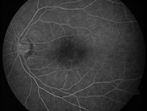 Juxtafoveal Telangiectasis - After Hemorrhage Absorbed Right Eye with Avastin Injections
73-year-old woman has juxtafoveal retinal telangiectasis in both eyes.  The right eye has stage 5 disease.  Her last Avastin treatment in the right eye was in 6 months ago.  The right eye has been the worst of her two eyes for years.

VISUAL ACUITY: Vision OD is 20/200, OS is 20/50.  


