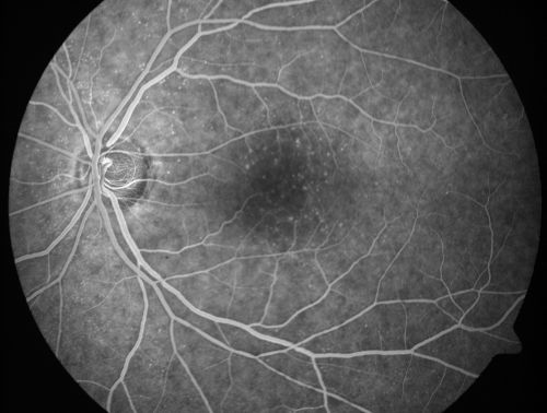 Juxtafoveal Telangiectasis - After Hemorrhage Absorbed Right Eye with Avastin Injections
73-year-old woman has juxtafoveal retinal telangiectasis in both eyes.  The right eye has stage 5 disease.  Her last Avastin treatment in the right eye was in 6 months ago.  The right eye has been the worst of her two eyes for years.

VISUAL ACUITY: Vision OD is 20/200, OS is 20/50.  

