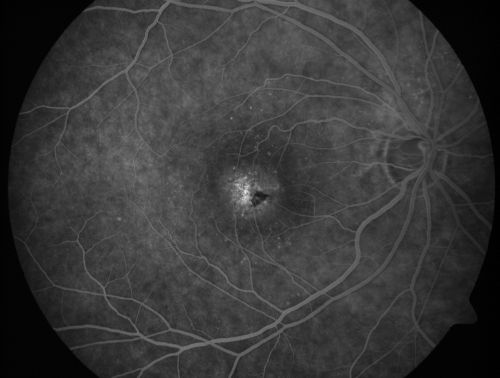 Juxtafoveal Telangiectasis - After Hemorrhage Absorbed Right Eye with Avastin Injections
73-year-old woman has juxtafoveal retinal telangiectasis in both eyes.  The right eye has stage 5 disease.  Her last Avastin treatment in the right eye was in 6 months ago.  The right eye has been the worst of her two eyes for years.

VISUAL ACUITY: Vision OD is 20/200, OS is 20/50.  


