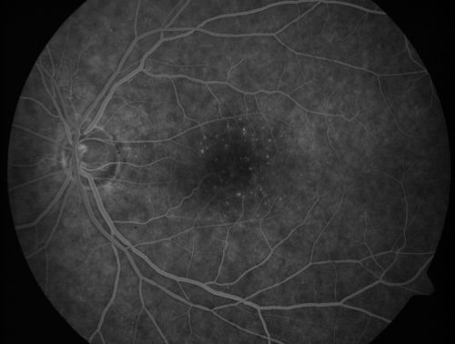 Juxtafoveal Telangiectasis - After Hemorrhage Absorbed Right Eye with Avastin Injections
73-year-old woman has juxtafoveal retinal telangiectasis in both eyes.  The right eye has stage 5 disease.  Her last Avastin treatment in the right eye was in 6 months ago.  The right eye has been the worst of her two eyes for years.

VISUAL ACUITY: Vision OD is 20/200, OS is 20/50.  

