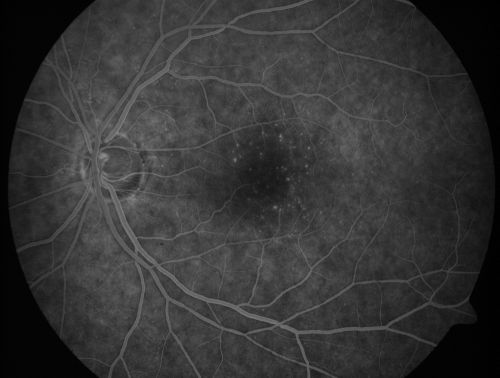 Juxtafoveal Telangiectasis - After Hemorrhage Absorbed Right Eye with Avastin Injections
73-year-old woman has juxtafoveal retinal telangiectasis in both eyes.  The right eye has stage 5 disease.  Her last Avastin treatment in the right eye was in 6 months ago.  The right eye has been the worst of her two eyes for years.

VISUAL ACUITY: Vision OD is 20/200, OS is 20/50.  

