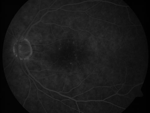Juxtafoveal Telangiectasis - After Hemorrhage Absorbed Right Eye with Avastin Injections
73-year-old woman has juxtafoveal retinal telangiectasis in both eyes.  The right eye has stage 5 disease.  Her last Avastin treatment in the right eye was in 6 months ago.  The right eye has been the worst of her two eyes for years.

VISUAL ACUITY: Vision OD is 20/200, OS is 20/50.  


