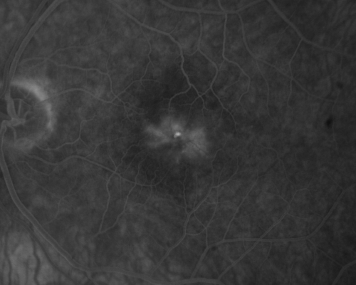 Group 2a Juxtafoveal Retinal Telangiectasis (type 2)
58-year-old man decreased vision right eye and not better since cataract surgery one year ago.  OD 20/40,  OS 20/40.
Keywords: ijft;mactel;crystals