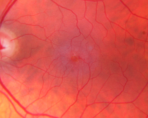 Group 2a Juxtafoveal Retinal Telangiectasis (type 2)
58-year-old man decreased vision right eye and not better since cataract surgery one year ago.  OD 20/40,  OS 20/40.
Keywords: ijft;mactel;crystals