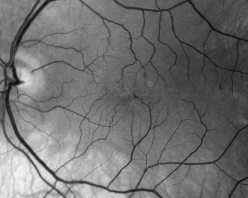Group 2a Juxtafoveal Retinal Telangiectasis (type 2)
58-year-old man decreased vision right eye and not better since cataract surgery one year ago.  OD 20/40,  OS 20/40.
Palabras clave: ijft;mactel;crystals