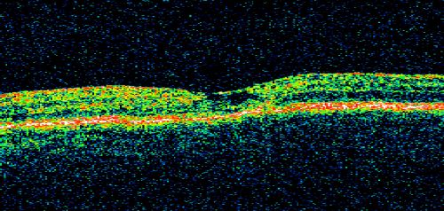 Group 2a Juxtafoveal Retinal Telangiectasis (type 2)
58-year-old man decreased vision right eye and not better since cataract surgery one year ago.  OD 20/40,  OS 20/40.
Schlüsselwörter: ijft;mactel;crystals