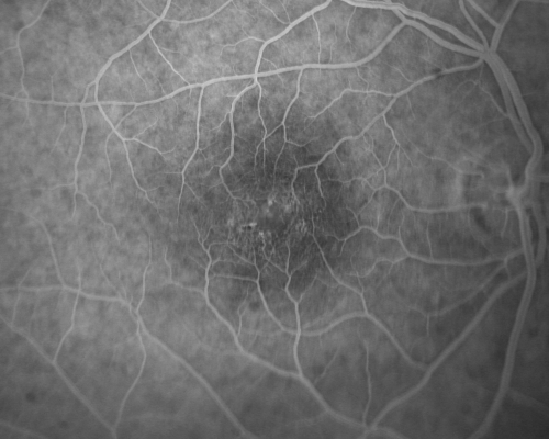 Group 2a Juxtafoveal Retinal Telangiectasis (type 2)
58-year-old man decreased vision right eye and not better since cataract surgery one year ago.  OD 20/40,  OS 20/40.
Keywords: ijft;mactel;crystals
