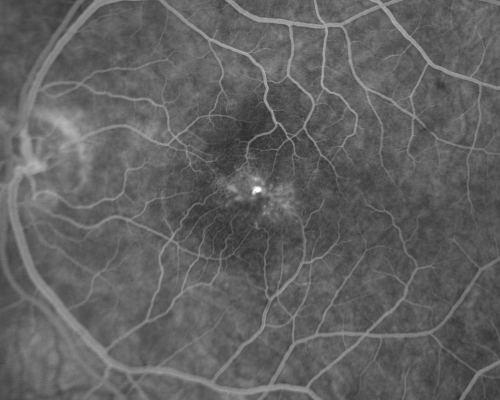 Group 2a Juxtafoveal Retinal Telangiectasis (type 2)
58-year-old man decreased vision right eye and not better since cataract surgery one year ago.  OD 20/40,  OS 20/40.
Keywords: ijft;mactel;crystals