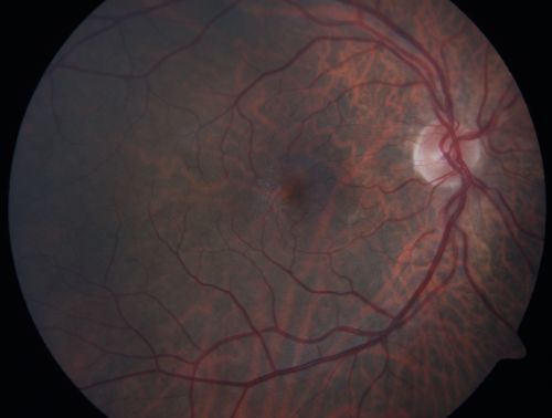 Group 2a Juxtafoveal Telangiectasis - MacTel - Idiopathic Juxtafoveal Macular Telangiectasia - Macular Hole
80-year-old man has juxtafoveal retinal telangiectasis in both eyes.  He also has a true full-thickness macular hole in the left eye.    The vision OD is 20/40, OS is 20/160

Group 2a Juxtafoveal Retinal Telangiectasis (telangiectasia), MacTel
