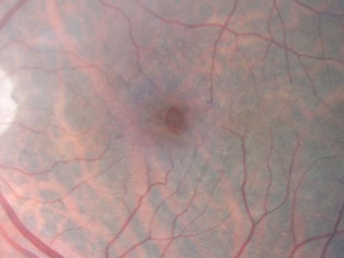 Group 2a Juxtafoveal Telangiectasis - MacTel - Idiopathic Juxtafoveal Macular Telangiectasia - Macular Hole
80-year-old man has juxtafoveal retinal telangiectasis in both eyes.  He also has a true full-thickness macular hole in the left eye.    The vision OD is 20/40, OS is 20/160

Group 2a Juxtafoveal Retinal Telangiectasis (telangiectasia), MacTel
