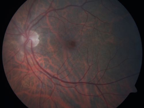 Group 2a Juxtafoveal Telangiectasis - MacTel - Idiopathic Juxtafoveal Macular Telangiectasia - Macular Hole
80-year-old man has juxtafoveal retinal telangiectasis in both eyes.  He also has a true full-thickness macular hole in the left eye.    The vision OD is 20/40, OS is 20/160

Group 2a Juxtafoveal Retinal Telangiectasis (telangiectasia), MacTel
