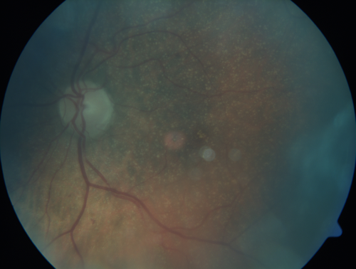 Unusual Intraretinal Deposits
71 year old diabetic man on dialysis with 20/20 vision and intraretinal deposits.  Recent 150 lb weight loss, on dialysis, see album properties for full history

