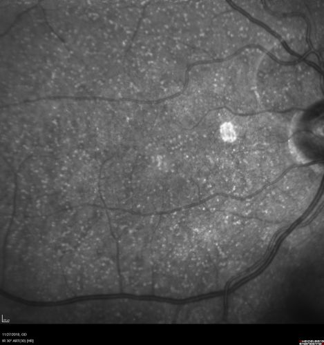 Unusual Intraretinal Deposits
71 year old diabetic man on dialysis with 20/20 vision and intraretinal deposits.  Recent 150 lb weight loss, on dialysis, see album properties for full history
