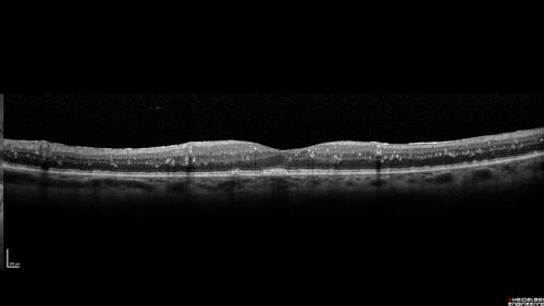 Unusual Intraretinal Deposits
71 year old diabetic man on dialysis with 20/20 vision and intraretinal deposits.  Recent 150 lb weight loss, on dialysis, see album properties for full history
