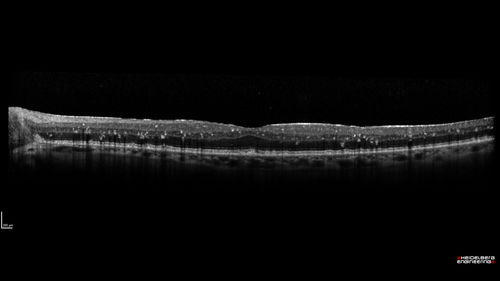 Unusual Intraretinal Deposits
71 year old diabetic man on dialysis with 20/20 vision and intraretinal deposits.  Recent 150 lb weight loss, on dialysis, see album properties for full history
