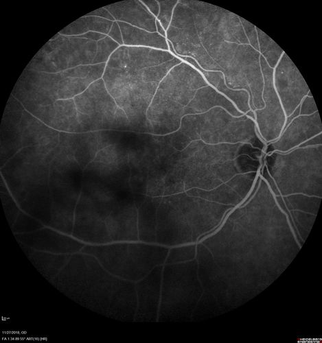 Unusual Intraretinal Deposits
71 year old diabetic man on dialysis with 20/20 vision and intraretinal deposits.  Recent 150 lb weight loss, on dialysis, see album properties for full history
