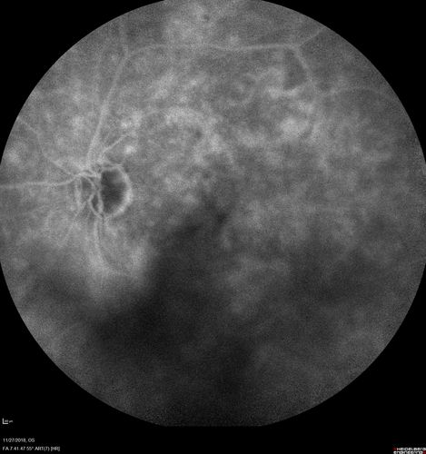 Unusual Intraretinal Deposits
71 year old diabetic man on dialysis with 20/20 vision and intraretinal deposits.  Recent 150 lb weight loss, on dialysis, see album properties for full history
