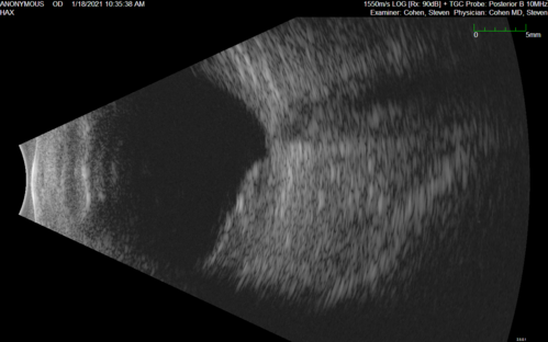 Massive subretinal hemorrhage right eye - polypoidal choroidal vasculopathy
Patient had sudden vision loss right eye.  Had vitrectomy.  The left eye had IPCV not responsive to avastin but he did respond to PDT.  See album notes for more detail.

