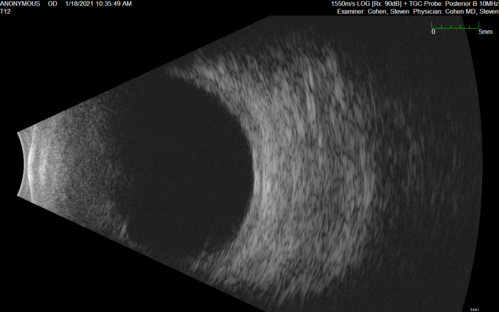 Massive subretinal hemorrhage right eye - polypoidal choroidal vasculopathy
Patient had sudden vision loss right eye.  Had vitrectomy.  The left eye had IPCV not responsive to avastin but he did respond to PDT.  See album notes for more detail.
