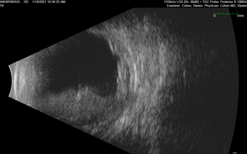 Massive subretinal hemorrhage right eye - polypoidal choroidal vasculopathy
Patient had sudden vision loss right eye.  Had vitrectomy.  The left eye had IPCV not responsive to avastin but he did respond to PDT.  See album notes for more detail.
