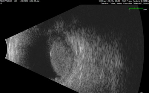Massive subretinal hemorrhage right eye - polypoidal choroidal vasculopathy
Patient had sudden vision loss right eye.  Had vitrectomy.  The left eye had IPCV not responsive to avastin but he did respond to PDT.  See album notes for more detail.
