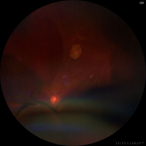 Massive subretinal hemorrhage right eye - polypoidal choroidal vasculopathy
Patient had sudden vision loss right eye.  Had vitrectomy.  The left eye had IPCV not responsive to avastin but he did respond to PDT.  See album notes for more detail.
