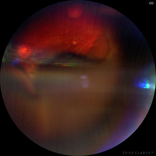 Massive subretinal hemorrhage right eye - polypoidal choroidal vasculopathy
Patient had sudden vision loss right eye.  Had vitrectomy.  The left eye had IPCV not responsive to avastin but he did respond to PDT.  See album notes for more detail.
