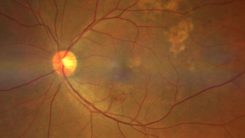 Massive subretinal hemorrhage right eye - polypoidal choroidal vasculopathy
Patient had sudden vision loss right eye.  Had vitrectomy.  The left eye had IPCV not responsive to avastin but he did respond to PDT.  See album notes for more detail.
