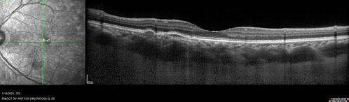 Massive subretinal hemorrhage right eye - polypoidal choroidal vasculopathy
Patient had sudden vision loss right eye.  Had vitrectomy.  The left eye had IPCV not responsive to avastin but he did respond to PDT.  See album notes for more detail.
