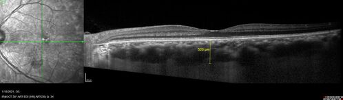 Massive subretinal hemorrhage right eye - polypoidal choroidal vasculopathy
Patient had sudden vision loss right eye.  Had vitrectomy.  The left eye had IPCV not responsive to avastin but he did respond to PDT.  See album notes for more detail.

