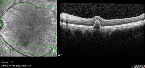 Massive subretinal hemorrhage right eye - polypoidal choroidal vasculopathy
Patient had sudden vision loss right eye.  Had vitrectomy.  The left eye had IPCV not responsive to avastin but he did respond to PDT.  See album notes for more detail.
