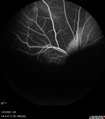 Massive subretinal hemorrhage right eye - polypoidal choroidal vasculopathy
Patient had sudden vision loss right eye.  Had vitrectomy.  The left eye had IPCV not responsive to avastin but he did respond to PDT.  See album notes for more detail.
