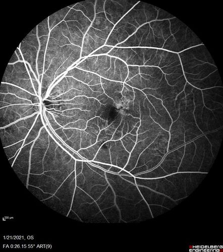Massive subretinal hemorrhage right eye - polypoidal choroidal vasculopathy
Patient had sudden vision loss right eye.  Had vitrectomy.  The left eye had IPCV not responsive to avastin but he did respond to PDT.  See album notes for more detail.
