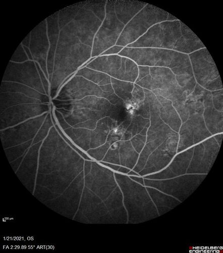 Massive subretinal hemorrhage right eye - polypoidal choroidal vasculopathy
Patient had sudden vision loss right eye.  Had vitrectomy.  The left eye had IPCV not responsive to avastin but he did respond to PDT.  See album notes for more detail.
