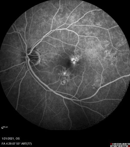 Massive subretinal hemorrhage right eye - polypoidal choroidal vasculopathy
Patient had sudden vision loss right eye.  Had vitrectomy.  The left eye had IPCV not responsive to avastin but he did respond to PDT.  See album notes for more detail.
