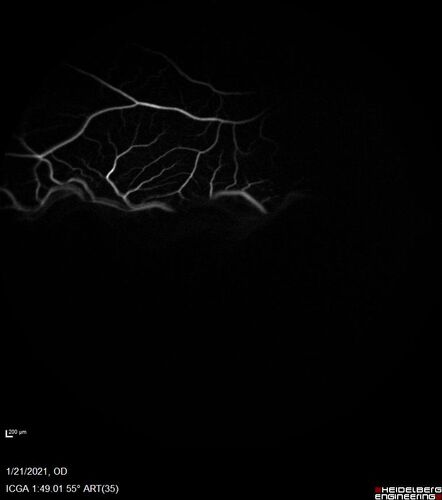 Massive subretinal hemorrhage right eye - polypoidal choroidal vasculopathy
Patient had sudden vision loss right eye.  Had vitrectomy.  The left eye had IPCV not responsive to avastin but he did respond to PDT.  See album notes for more detail.
