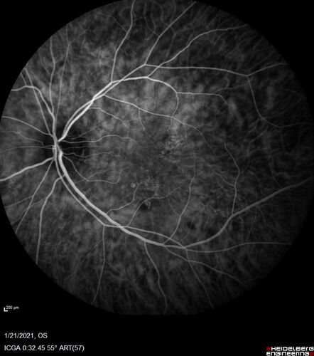 Massive subretinal hemorrhage right eye - polypoidal choroidal vasculopathy
Patient had sudden vision loss right eye.  Had vitrectomy.  The left eye had IPCV not responsive to avastin but he did respond to PDT.  See album notes for more detail.

