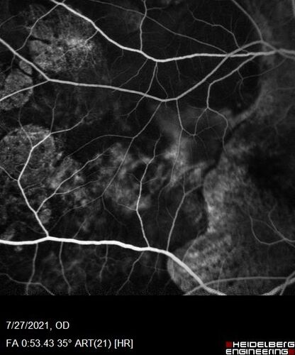 Massive subretinal hemorrhage right eye - polypoidal choroidal vasculopathy
Patient had sudden vision loss right eye.  Had vitrectomy.  The left eye had IPCV not responsive to avastin but he did respond to PDT.  See album notes for more detail.
