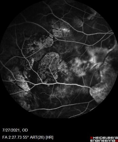 Massive subretinal hemorrhage right eye - polypoidal choroidal vasculopathy
Patient had sudden vision loss right eye.  Had vitrectomy.  The left eye had IPCV not responsive to avastin but he did respond to PDT.  See album notes for more detail.
