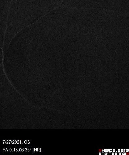 Massive subretinal hemorrhage right eye - polypoidal choroidal vasculopathy
Patient had sudden vision loss right eye.  Had vitrectomy.  The left eye had IPCV not responsive to avastin but he did respond to PDT.  See album notes for more detail.
