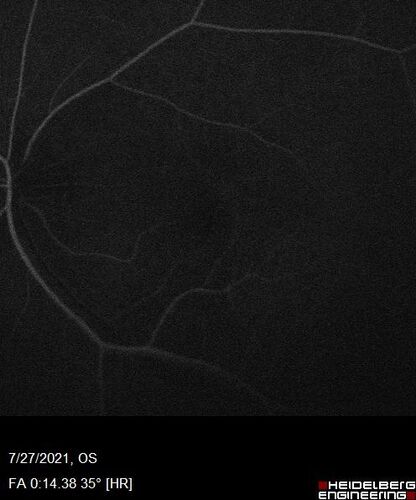 Massive subretinal hemorrhage right eye - polypoidal choroidal vasculopathy
Patient had sudden vision loss right eye.  Had vitrectomy.  The left eye had IPCV not responsive to avastin but he did respond to PDT.  See album notes for more detail.
