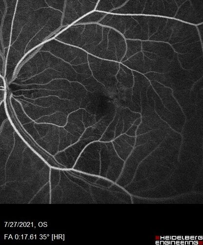 Massive subretinal hemorrhage right eye - polypoidal choroidal vasculopathy
Patient had sudden vision loss right eye.  Had vitrectomy.  The left eye had IPCV not responsive to avastin but he did respond to PDT.  See album notes for more detail.
