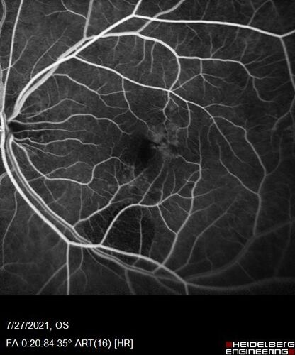 Massive subretinal hemorrhage right eye - polypoidal choroidal vasculopathy
Patient had sudden vision loss right eye.  Had vitrectomy.  The left eye had IPCV not responsive to avastin but he did respond to PDT.  See album notes for more detail.
