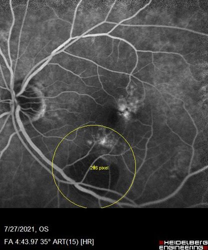 Massive subretinal hemorrhage right eye - polypoidal choroidal vasculopathy
Patient had sudden vision loss right eye.  Had vitrectomy.  The left eye had IPCV not responsive to avastin but he did respond to PDT.  See album notes for more detail.
